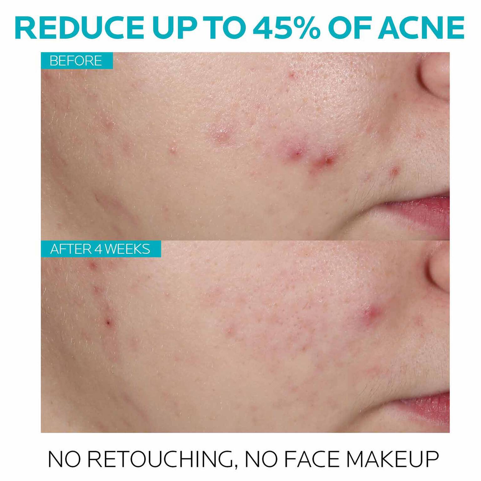 effaclar-salicylic-acid-acne-treatment-serum-k5 7_EffaclarSerum_After-45-days.jpg