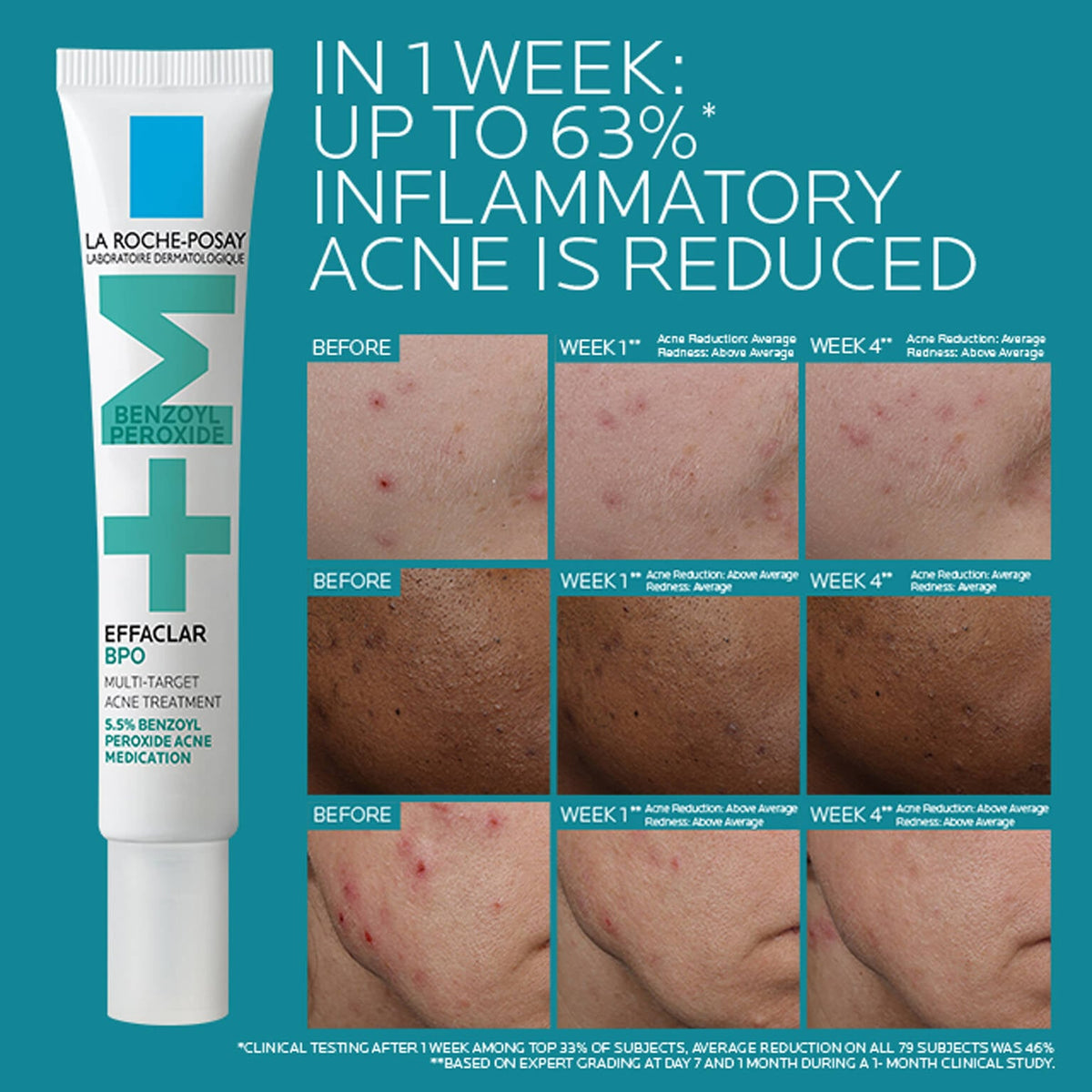 effaclar-bpo-multi-target-acne-treatment-with-5-5-benzoyl-peroxide-l5 EffaclarBPO-ClinicalBA-ATF-1500x1500-2.jpg