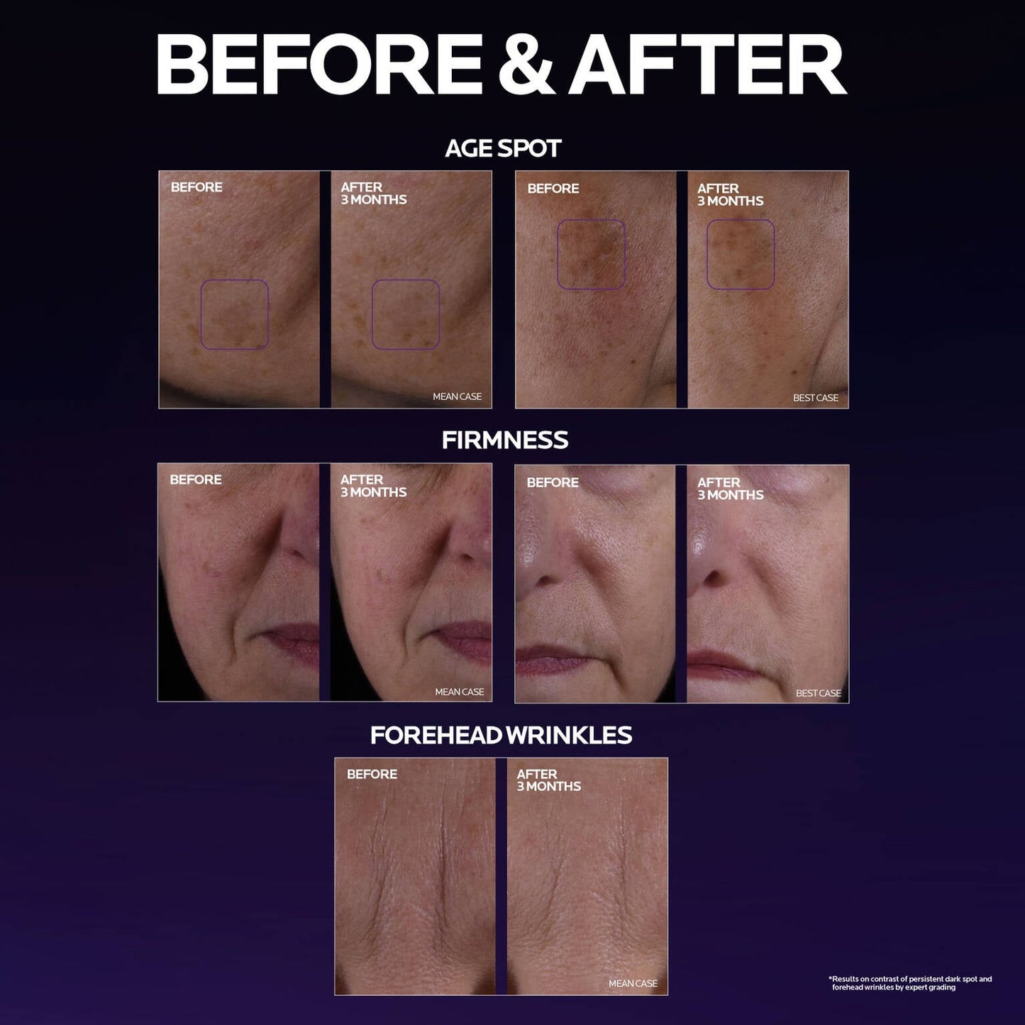 mela-b3-double-dose-discoloration-treatment-with-melasyltm-x6 MelaB3_DD_BTF_BeforeAfter_1500x1500_5.jpg