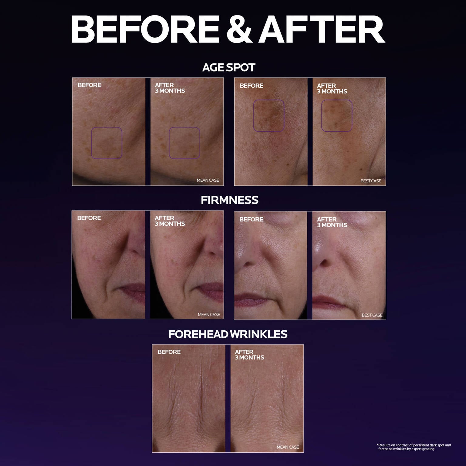 mela-b3-double-dose-discoloration-treatment-with-melasyltm-x6 MelaB3_DD_BTF_BeforeAfter_1500x1500_5.jpg